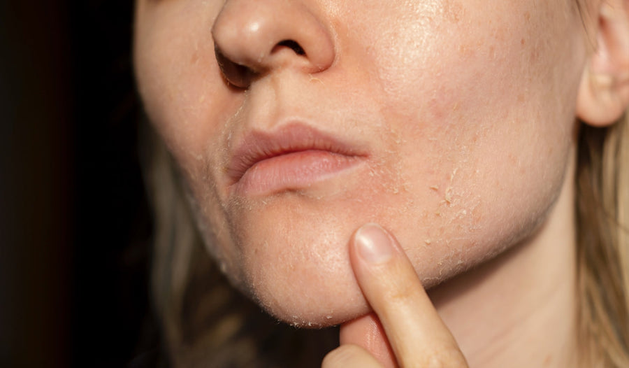 How To Fix A Damaged Skin Barrier