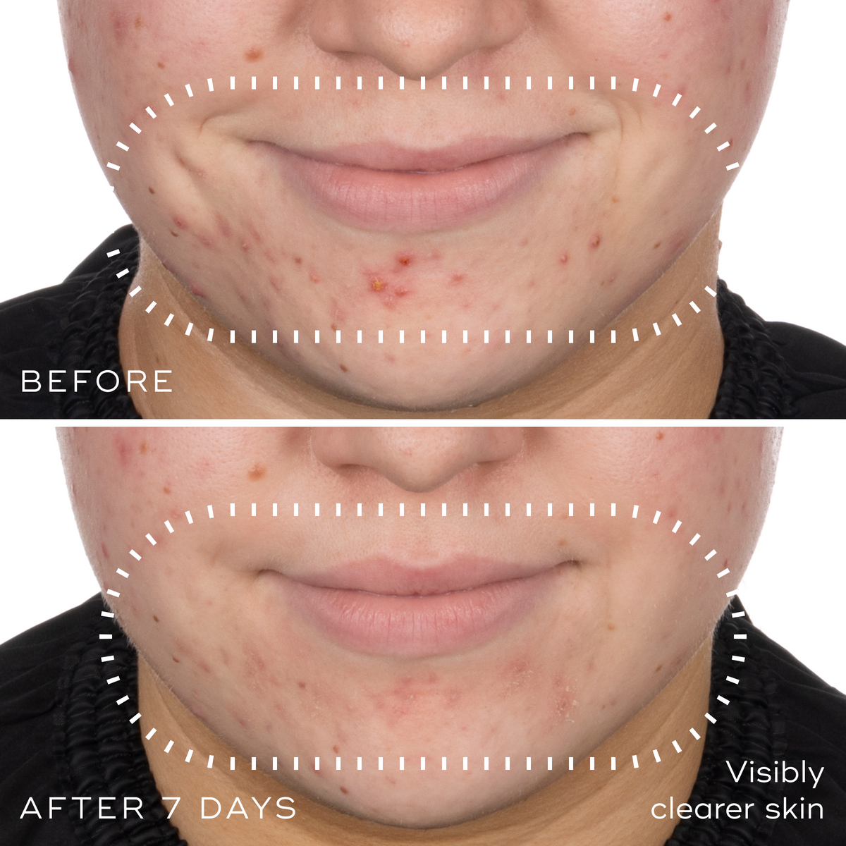 Before and after photographs of a woman's chin and jawline after 7 days using Medik8 Niacinamide Peptides, showing visibly clearer skin.