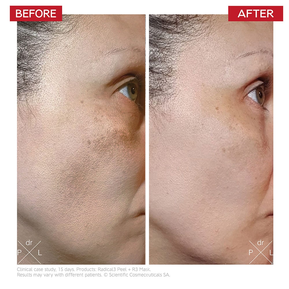 Dr Levy Radical3 Reboot Pro Peel 50ml — image 3